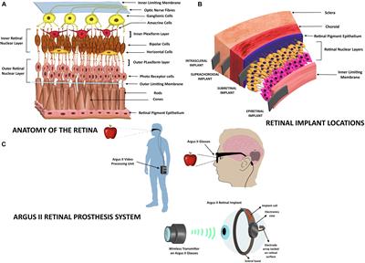 Neurosensory Prosthetics: An Integral Neuromodulation Part of Bioelectronic Device